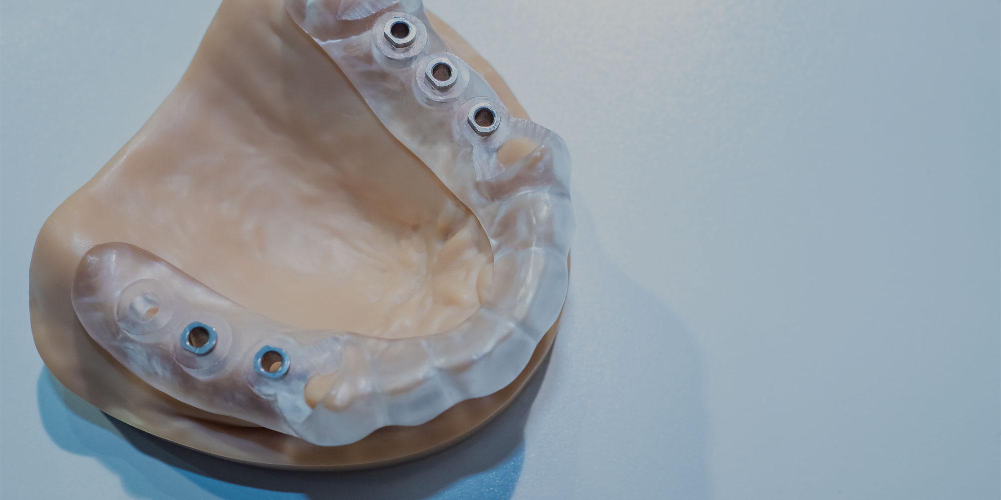 Restorative Implants